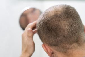 Metade dos homens convive com queda de cabelo aos 50 anos e maioria não trata